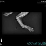Grace Wrist X-Ray #2