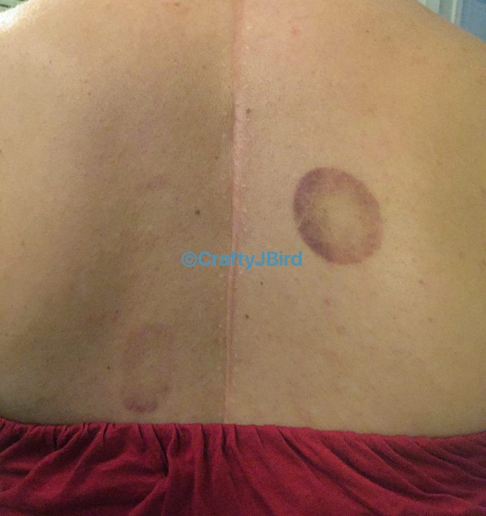 My Cupping Experience -- Visit CraftyJBird.com for more info