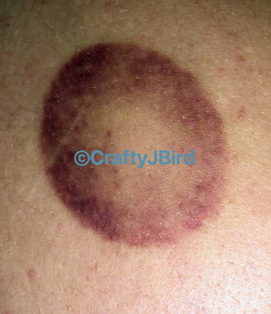 My Cupping Experience -- Visit CraftyJBird.com for more info