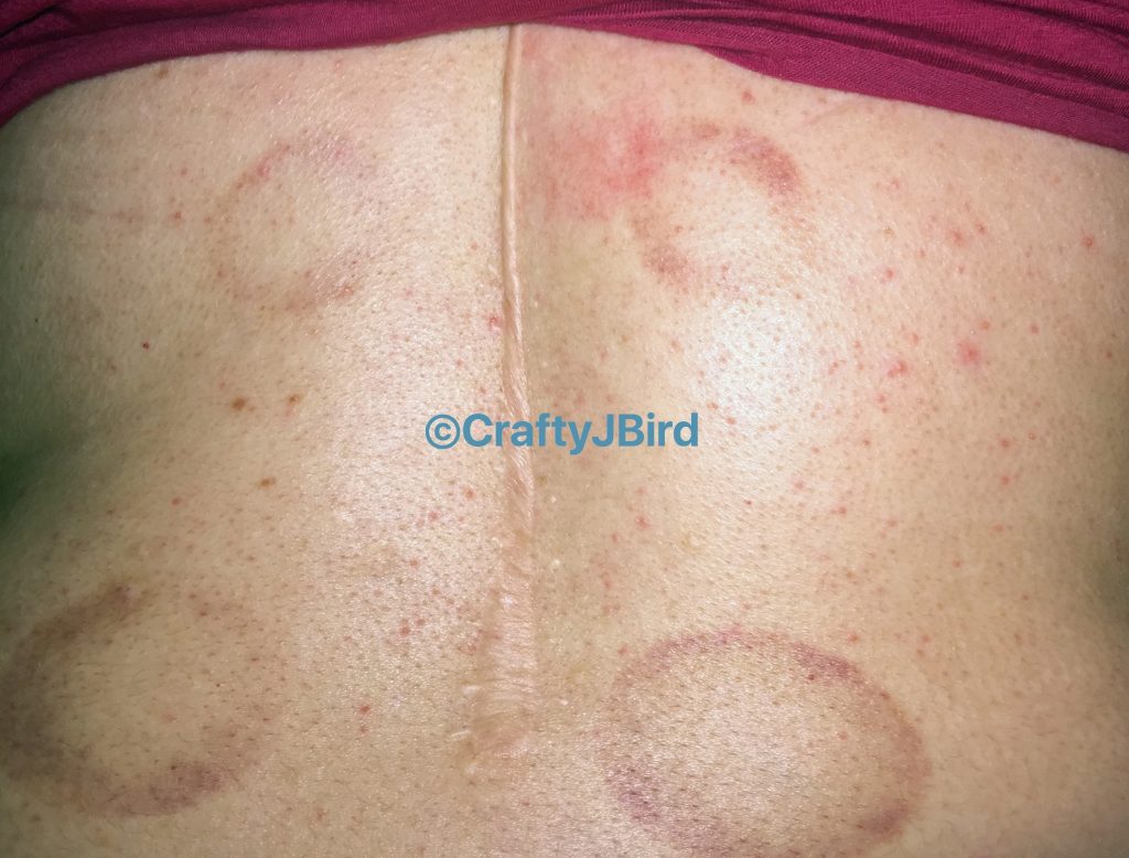 My Cupping Experience -- Visit CraftyJBird.com for more info
