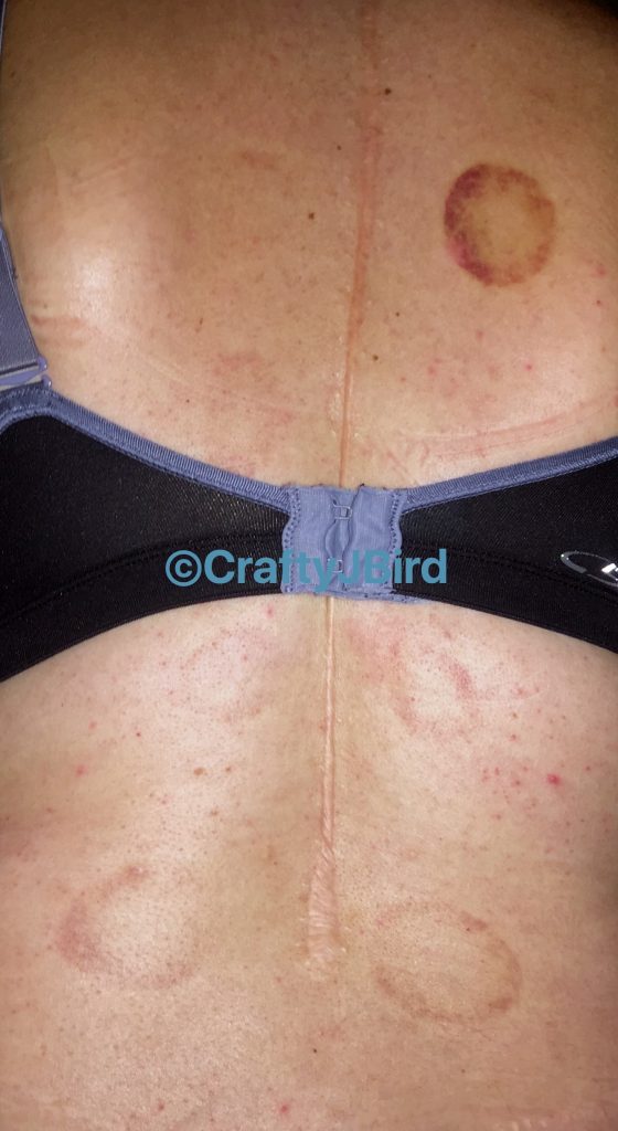 My Cupping Experience -- Visit CraftyJBird.com for more info