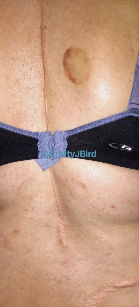 My Cupping Experience -- Visit CraftyJBird.com for more info