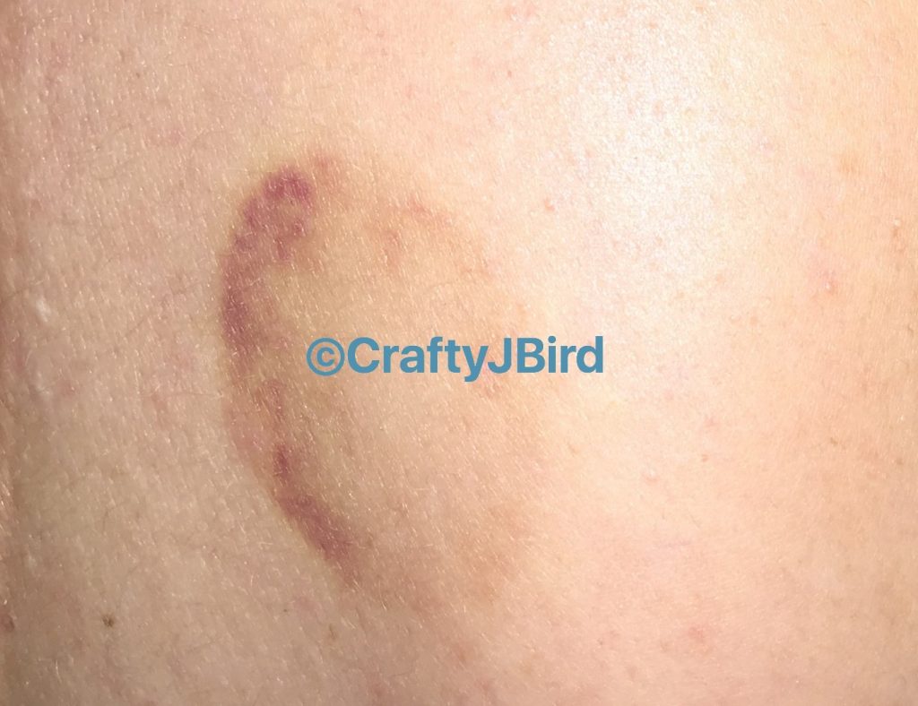 My Cupping Experience -- Visit CraftyJBird.com for more info