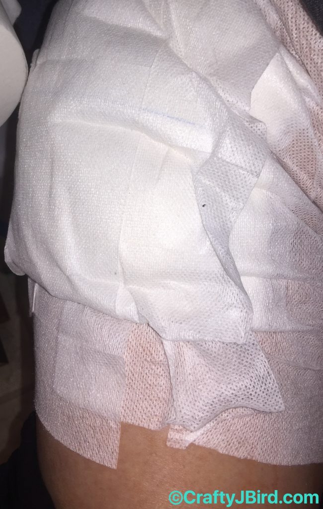 Hip Scope Surgery Part 2 -- Visit CraftyJBird.com for more info... 